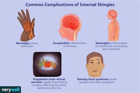shingles complications