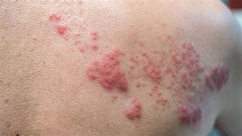 shingles and older adults