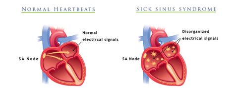 Sick Sinus Syndrome