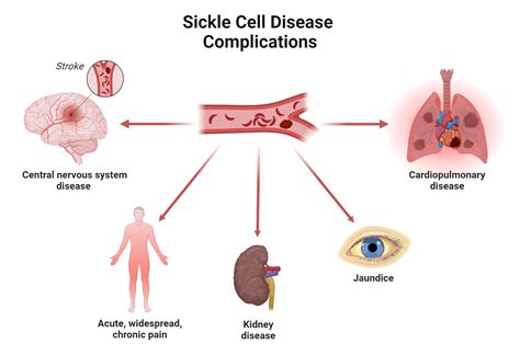 Sickle Cell Crisis Complications