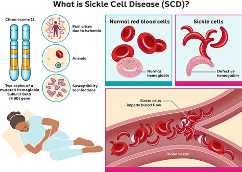 sickle cell disease