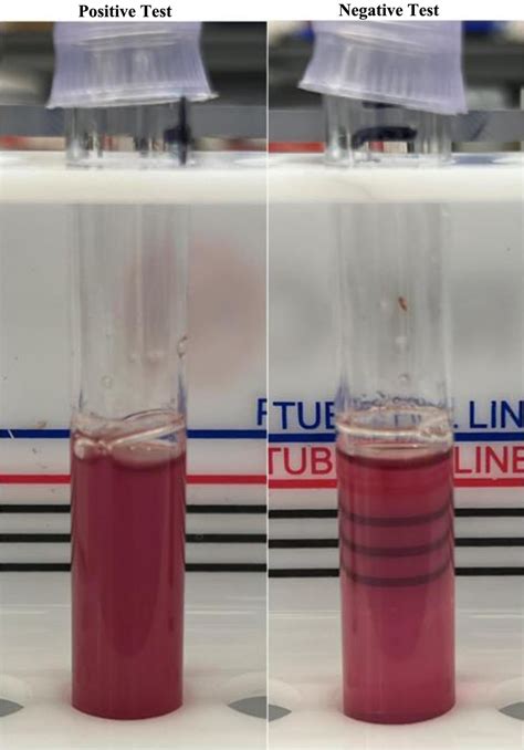 Sickle Cell Solubility Testing