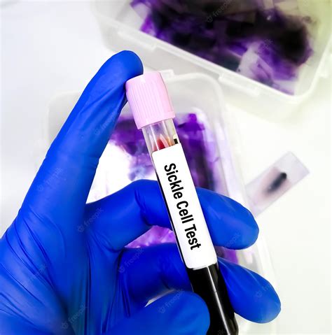Sickle Cell Testing