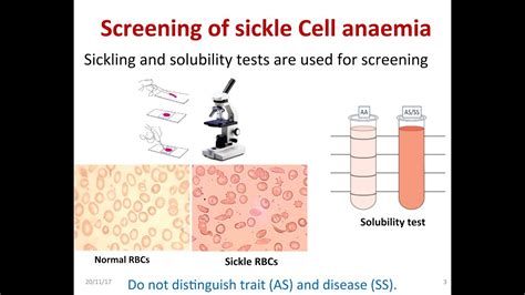 sickle cell tests