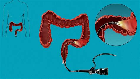 Sigmoidoscopy procedure