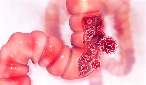 Sigmoidoscopy and colon cancer screening