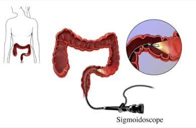 Sigmoidoscopy conclusion and final thoughts
