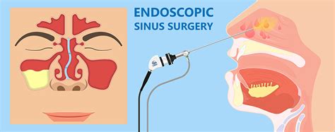 sinus surgery procedures