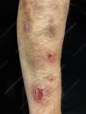 skin picking disorder