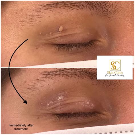 skin tag removal methods