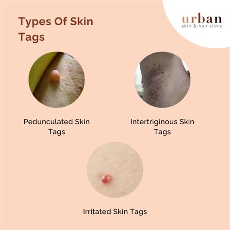 skin tags