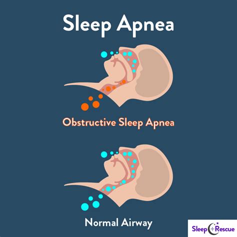 Sleep Apnea Conclusion