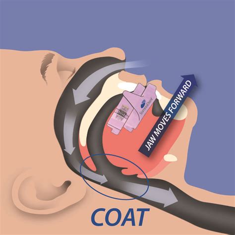 Sleep Apnea Mouth Device Alternatives