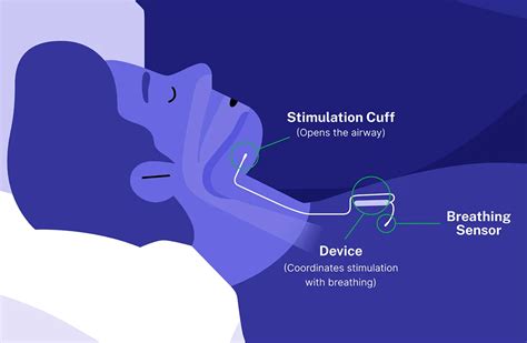 Sleep Apnea Surgery Benefits