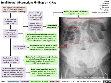 Small bowel obstruction diagram