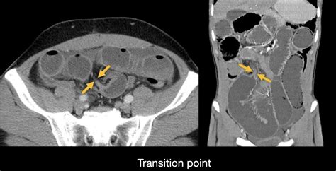 small intestine blockage
