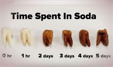 soda water tooth decay