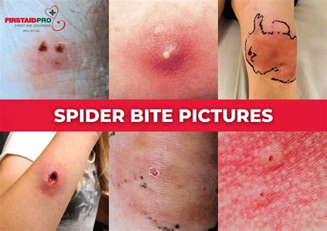 Spider Bite Infections
