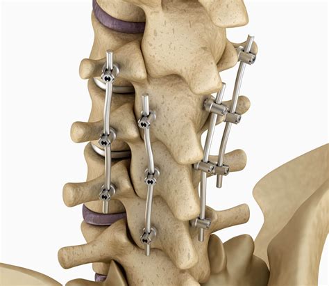 spinal fusion surgery
