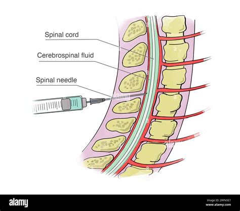 spinal tap expectations
