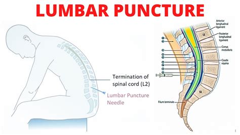 spinal tap facts