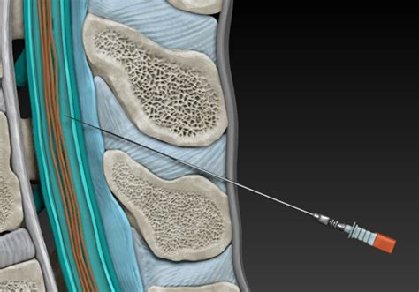 spinal tap procedure