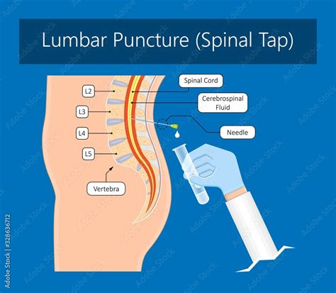 spinal tap test