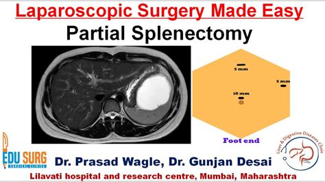 spleen surgery