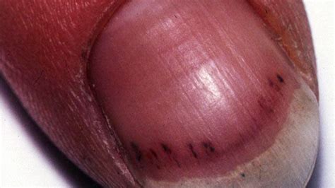 Symptoms of splinter hemorrhage