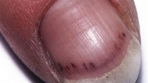 Treatment options for splinter hemorrhage