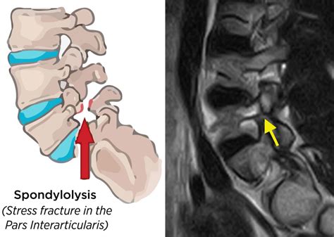 Spondylosis Definition