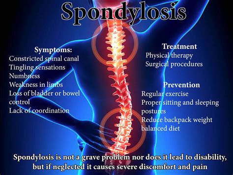 Spondylosis Quality of Life