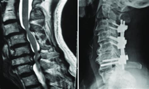 Spondylosis Research