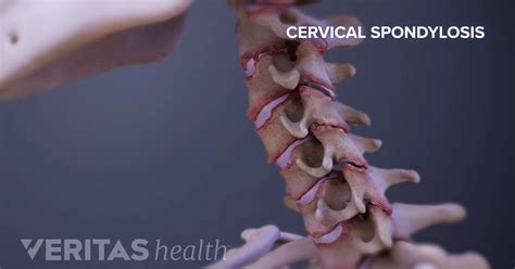 Spondylosis Resources