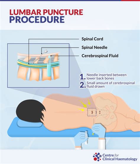 Steps Involved in Lumbar Puncture Procedure