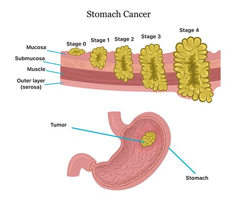 stomach cancer research