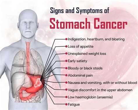 stomach cancer symptoms