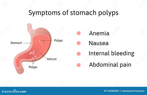 Stomach Polyps Symptoms