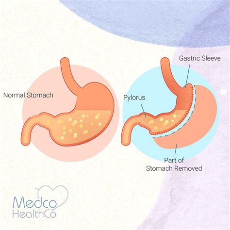 stomach sleeve surgery