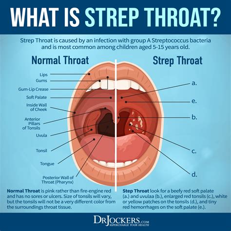 Strep Throat Symptoms