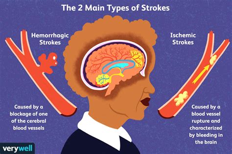 Causes and Risk Factors of Stroke