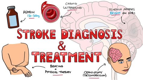Treatment Options for Stroke