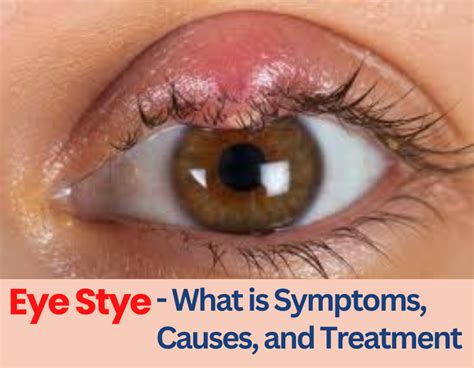 Stye symptoms