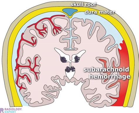 Subarachnoid Hemorrhage