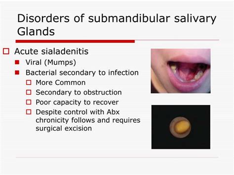 submandibular gland issues