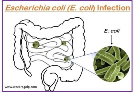 Supportive Care for E. coli Infections