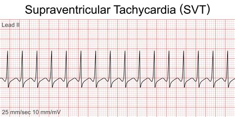 Supraventricular Tachycardia