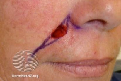 Surgical Excision