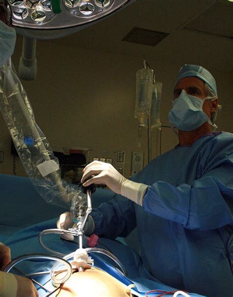 Surgical Excision for Moles