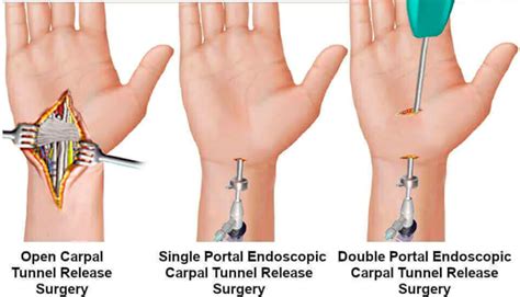 Surgical Interventions for Carpal Tunnel Syndrome